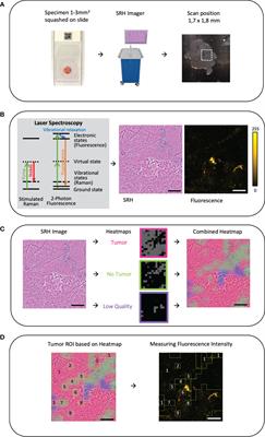 Intraoperative microscopic autofluorescence detection and characterization in brain tumors using stimulated Raman histology and two-photon fluorescence